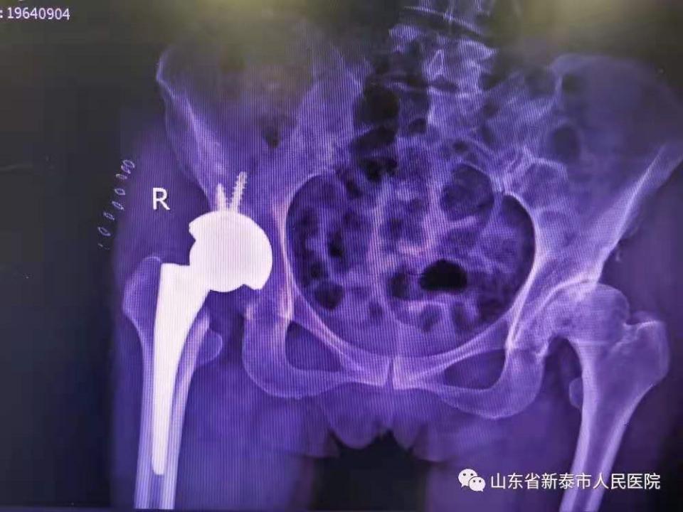 股骨头坏死最新疗法
